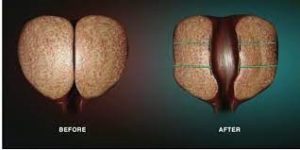 Urolift
