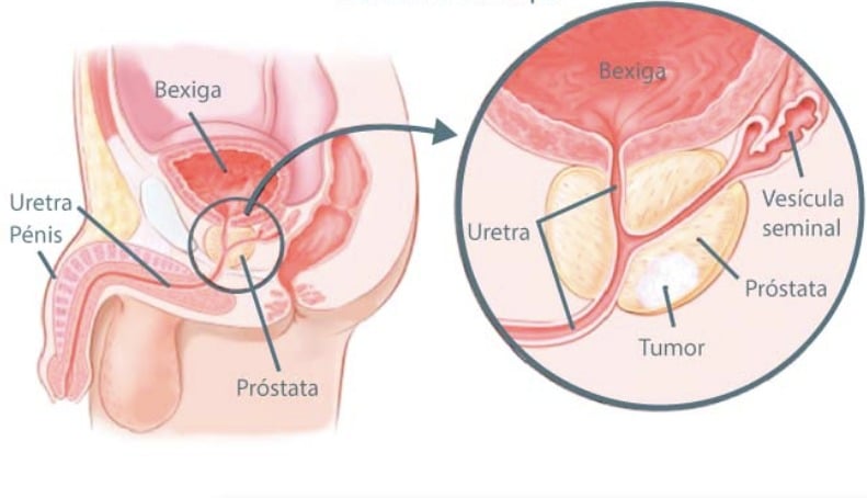 Câncer de Próstata Dr Nilo Jorge