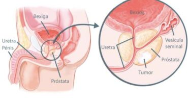 Câncer de Próstata